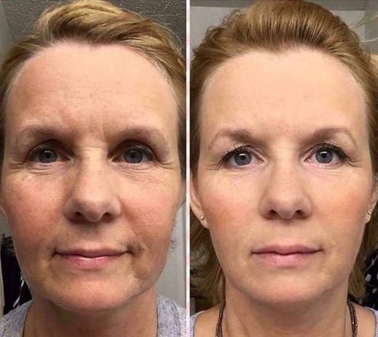 face-gymnastics-facial-exercises-look-younger (156)